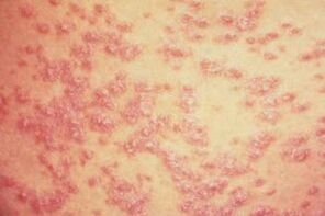 plaques rouges sur la peau avec psoriasis