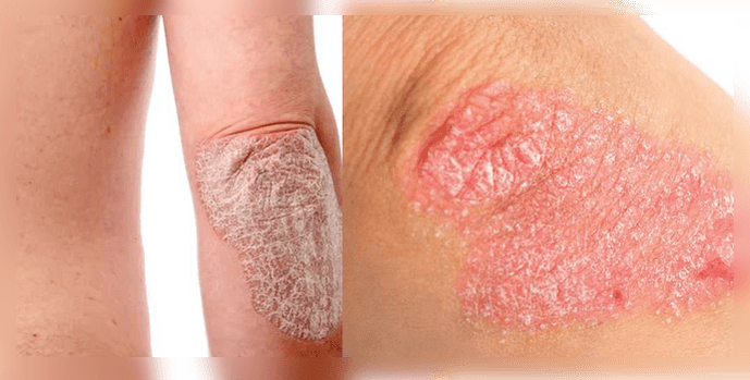À quoi ressemble le psoriasis sur la peau