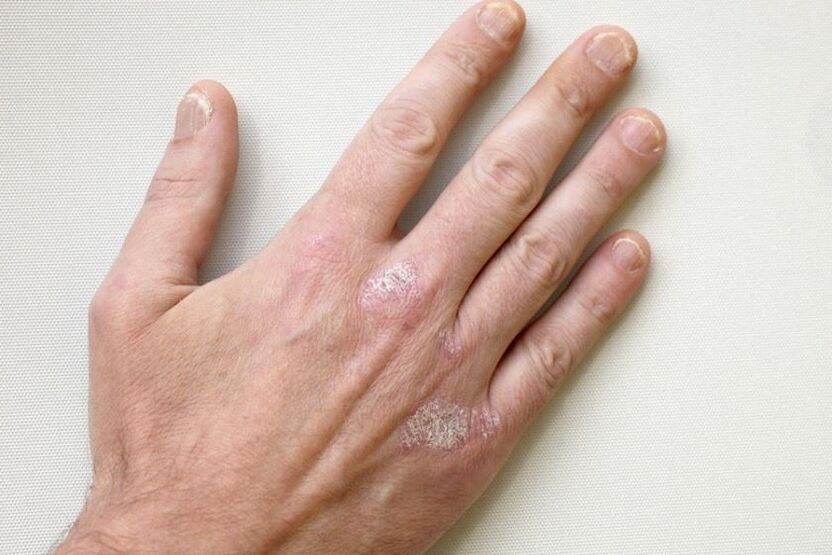 Les plaques squameuses sur la peau sont un symptôme obligatoire du psoriasis. 