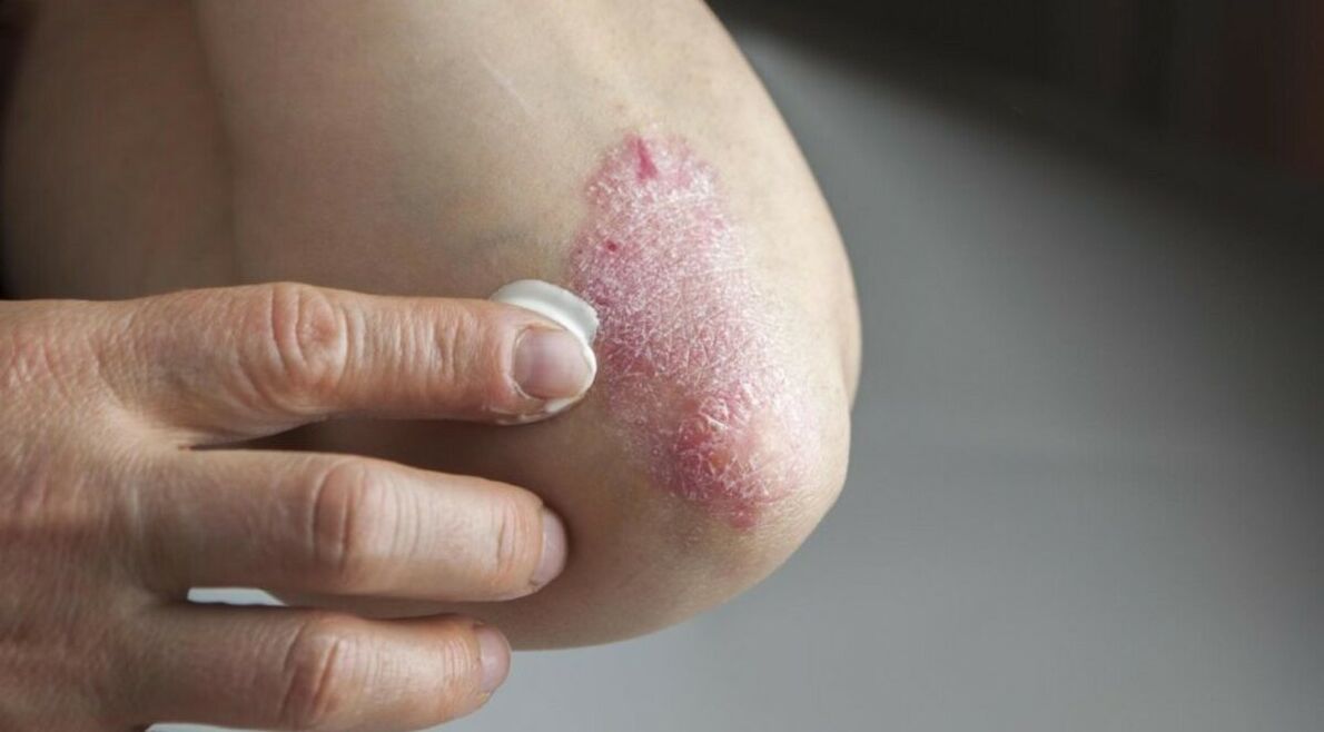 Psoriasis qui affecte la peau, dont le traitement comprend l'utilisation de pommades. 