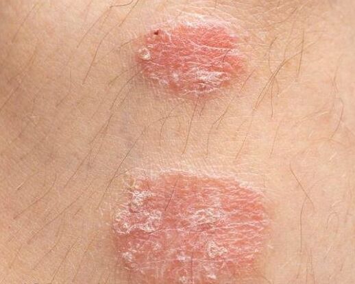 Apparence des plaques psoriasiques