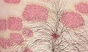 Plusieurs formations de roses dans l'abdomen