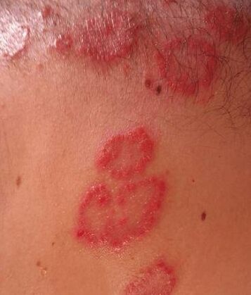 Spots psoriasis