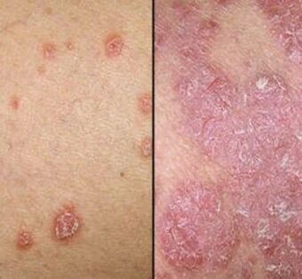 Plaques psoriatiques