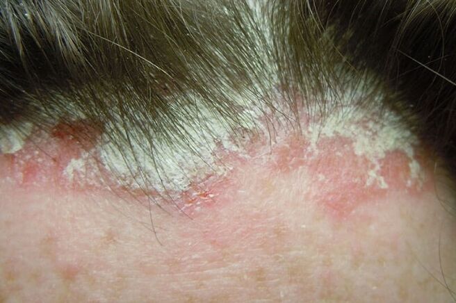 Le psoriasis capture toute la partie velue de la tête