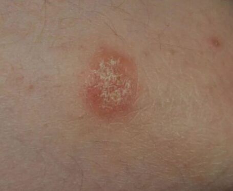 Lieu de psoriasis