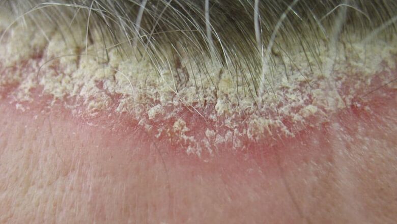 Psoriasis du cuir chevelu