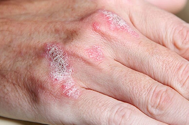 Psoriasis soutenu par le ladomary