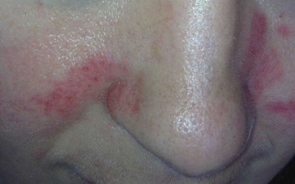 Symptômes du psoriasis sur le visage