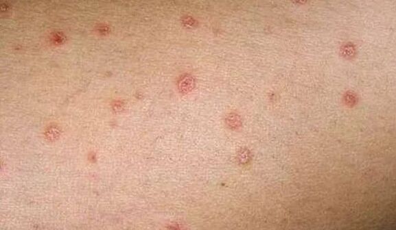 L'étape initiale du psoriasis