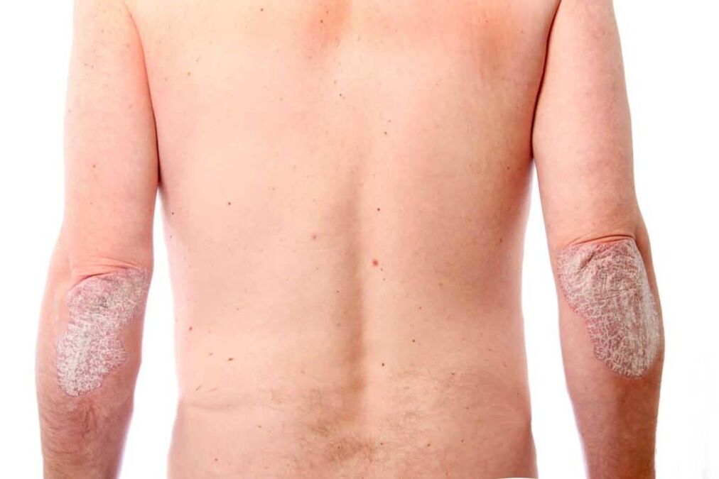 La deuxième étape du psoriasis