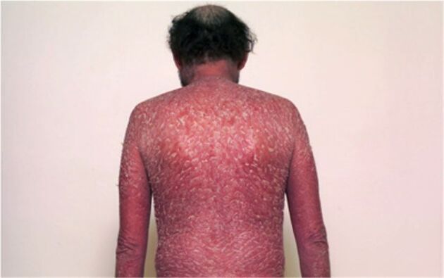 La troisième étape du psoriasis