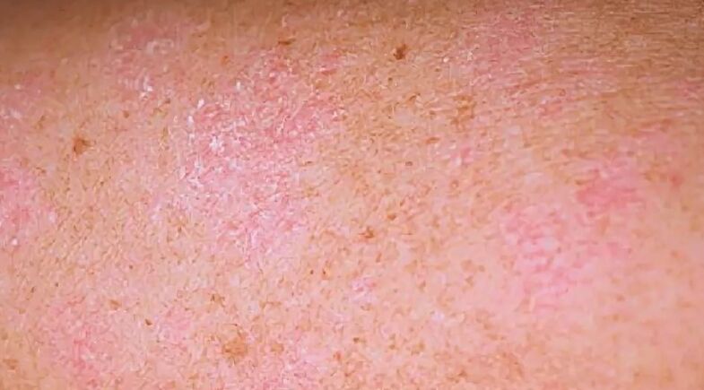 Le stade régressif du psoriasis