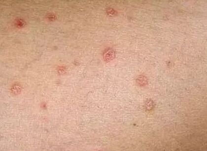 Psoriasis de l'étape initiale