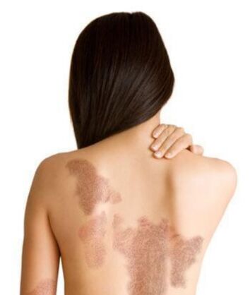 Étapes du psoriasis en fonction de la zone de blessure