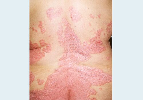 Dos psoriasis