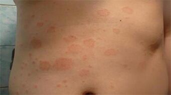 Psoriasis dans l'estomac