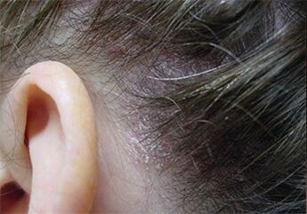 Psoriasis dans la tête
