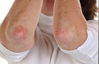 Psoriasis dans les coudes