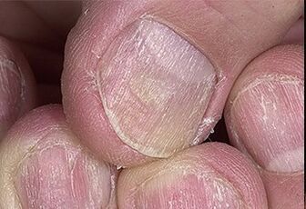 Psoriasis de clou