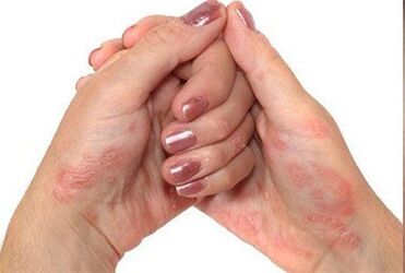 Psoriasis entre les mains