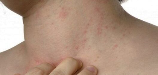 Psoriasis sur le cou