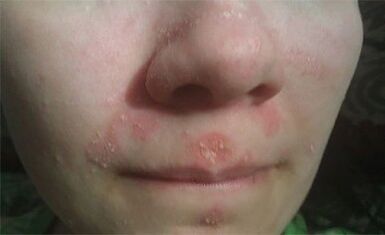 Psoriasis sur le visage