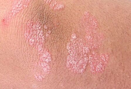 Triasis