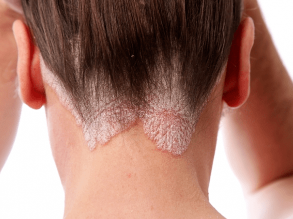 Psoriasis dans la tête