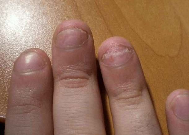 Psoriasis de clou