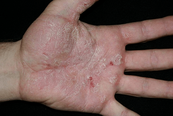 Psoriasis entre les mains