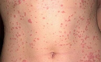 Psoriasis dans le corps