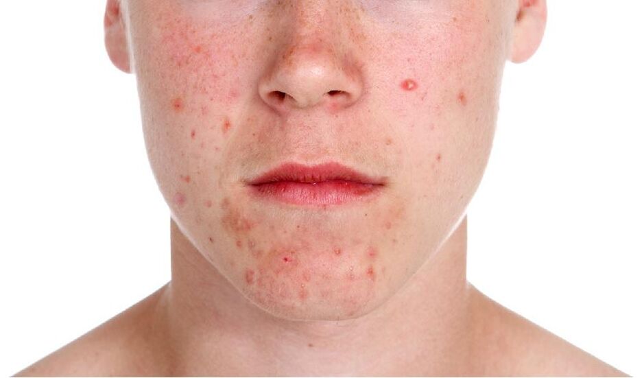 Psoriasis sur le visage