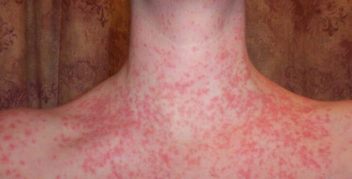 Psoriasis dans le corps