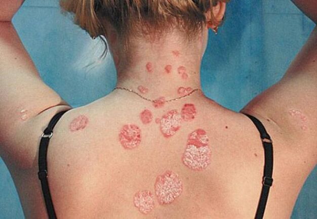 Psoriasis à l'arrière
