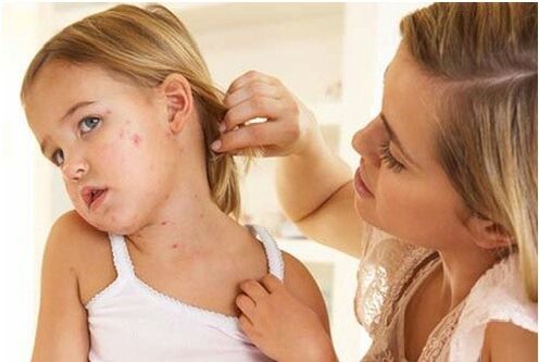 Photo de l'étape initiale du psoriasis