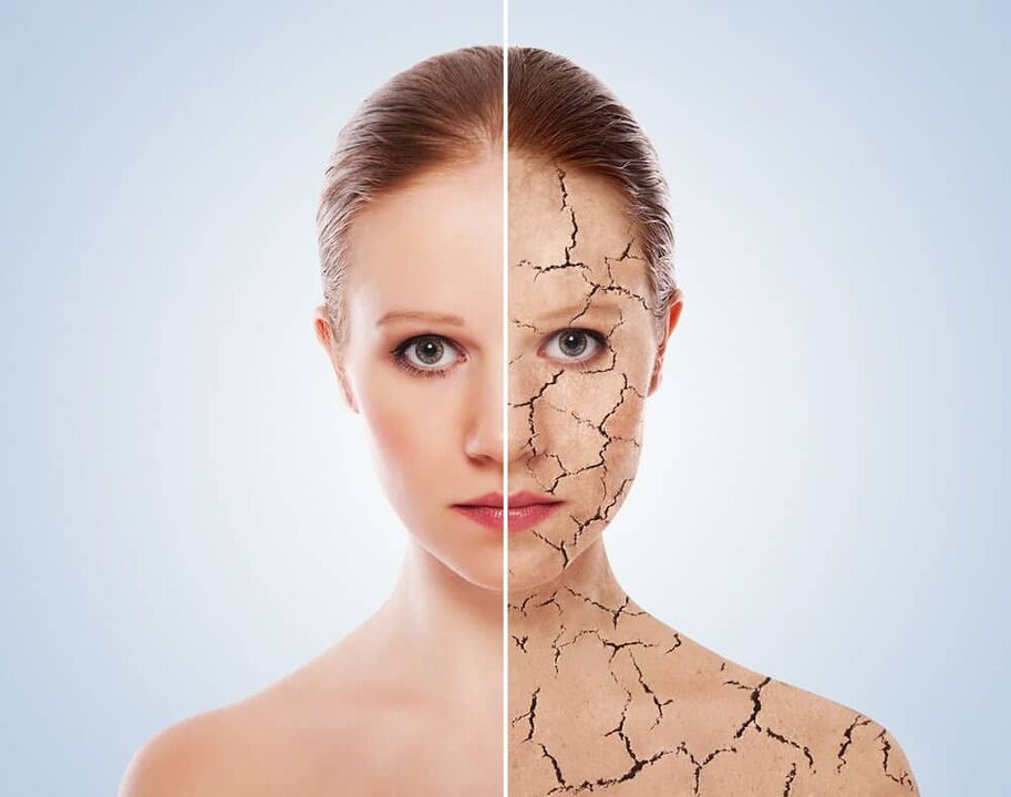 Peau saine et peau affectée par le psoriasis
