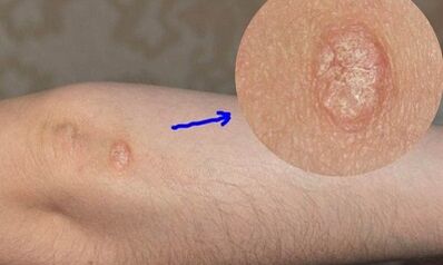 stades de développement du psoriasis