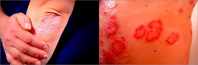 Psoriasis en plaques