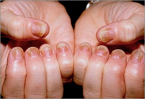 psoriasis des ongles
