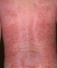 érythrodermie