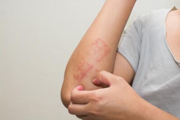 Les dernières méthodes pour traiter le psoriasis