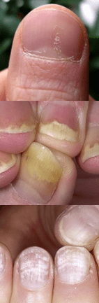 Psoriasis de clou - étape initiale