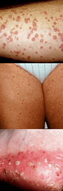 Psoriasis de jambe