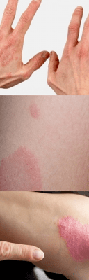 Psoriasis de l'étape initiale entre les mains