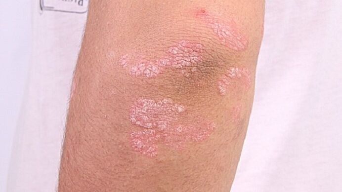 photo du psoriasis à un stade précoce