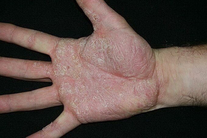 psoriasis des paumes et des pieds
