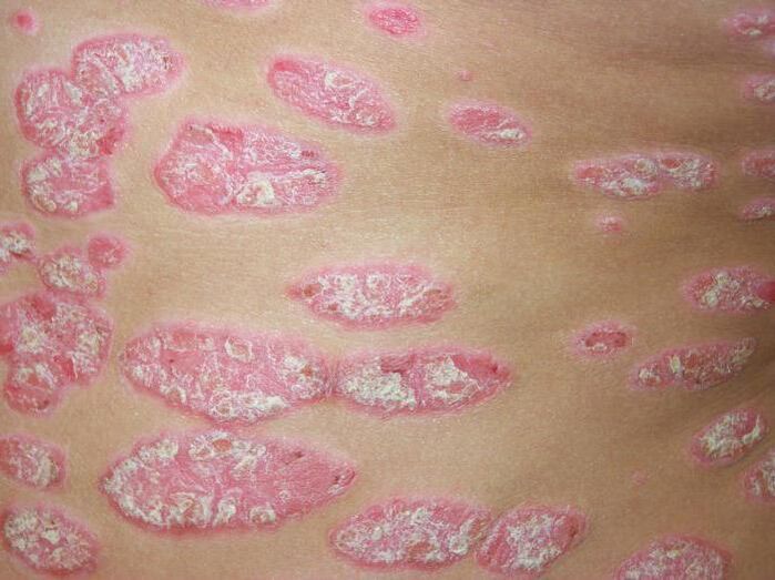psoriasis en plaques