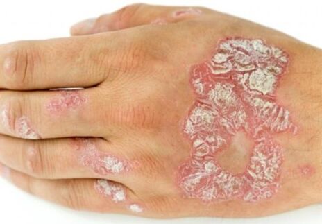psoriasis sur la main